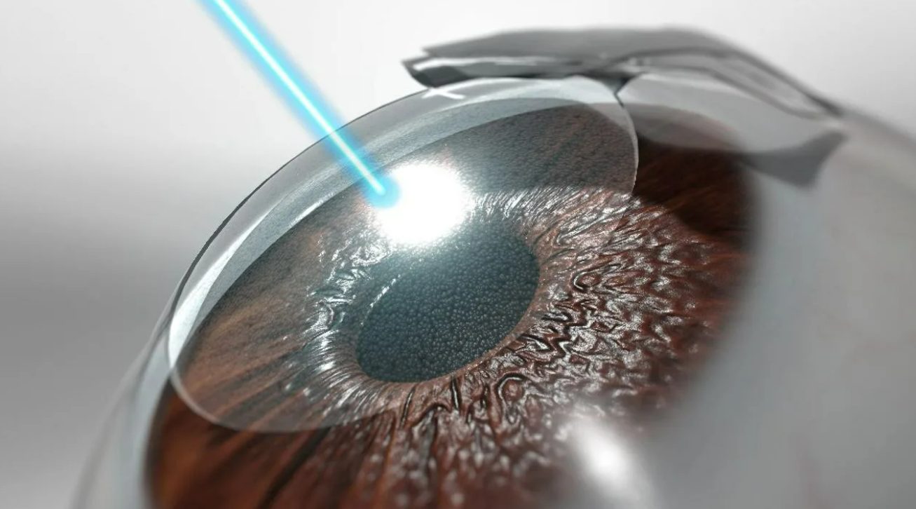 почему врачи не делают себе лазерную коррекцию зрения